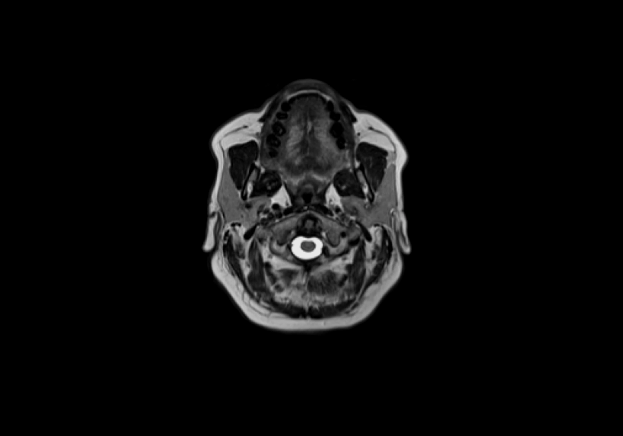 Neck axial  lymph node cross sectional MRI anatomy 3T MRI  image-img-00001-00031.webp